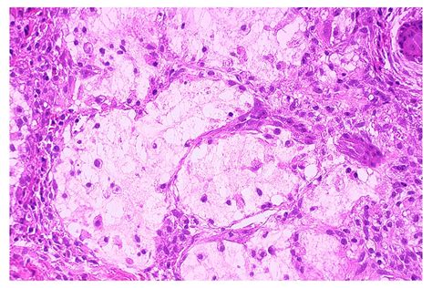 Necrotizing Sialometaplasia Histology