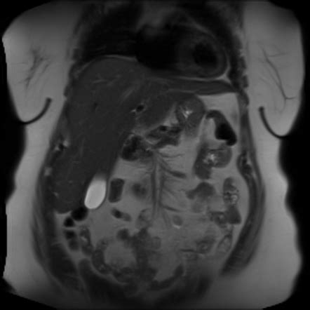 Insulinoma | Image | Radiopaedia.org