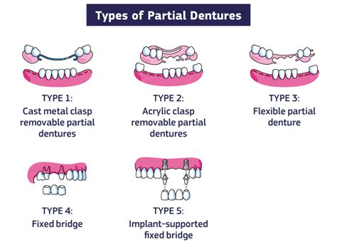 Types Of Fixed Partial Denture. – Total Dental Care