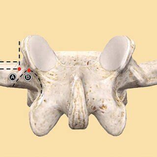 Schematic diagram of entry point (A). The entry point is positioned at... | Download Scientific ...