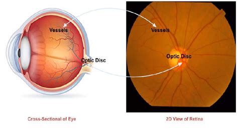 Optic Disc