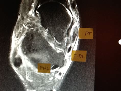 Foot and Ankle Problems By Dr. Richard Blake: Posterior Tibial Tendon ...