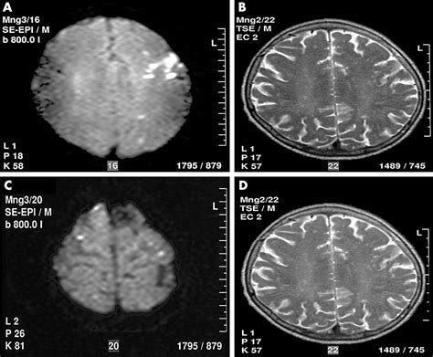 Clinical significance of detection of multiple acute brain infarcts on ...