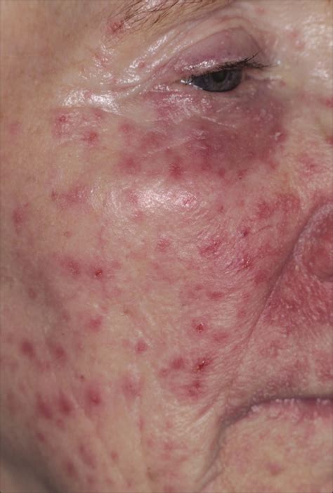 Rosacealike Dermatitis With Candida albicans Infection | Dermatology | JAMA Dermatology | The ...