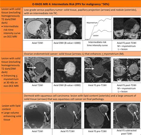 O-RADS MRI Calculator - RadioGyan