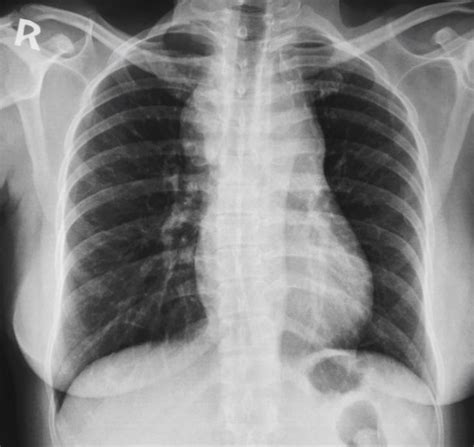 Mediastinal Hodgkin's lymphoma | Radiology Case | Radiopaedia.org | Hodgkins lymphoma, Lymphoma ...