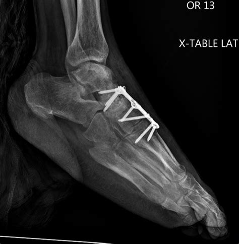 talonavicular joint | The Foot and Ankle Online Journal