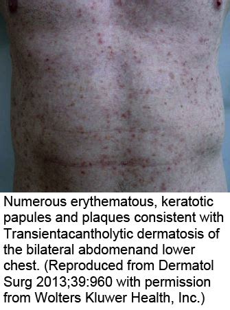 Pathology Outlines - Transient acantholytic dermatosis (Grover disease)