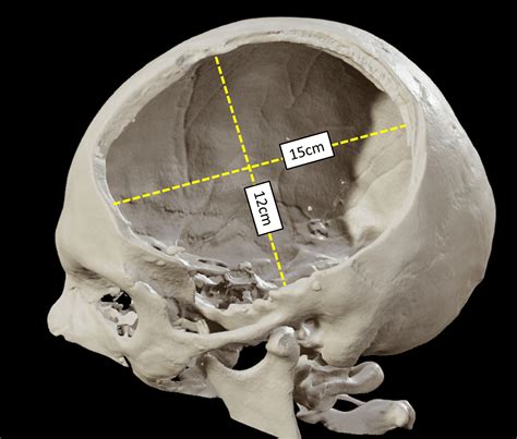 Cureus | Primary Decompressive Craniectomy After Traumatic Brain Injury: A Literature Review