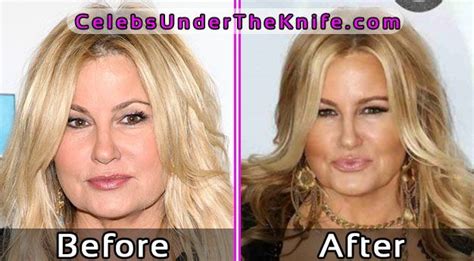 Jennifer Coolidge Botox