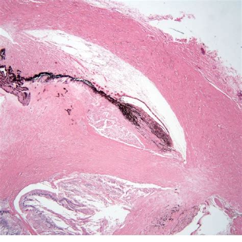 Histopathology of the enucleated eye of case 18. Transscleral scarring ...