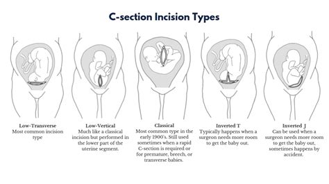 VBAC vs Repeat C-Section: Which is Right for You?