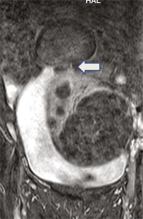 RADIODIAGNOSIS - IMAGE COLLECTION: PEDUNCULATED SUBSEROSAL FIBROID