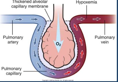 Acute Respiratory Failure Flashcards | Quizlet