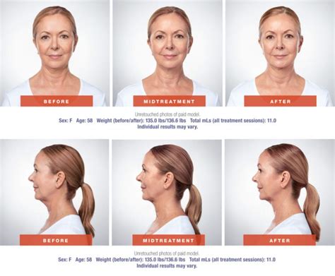 Kybella double chin reduction injection Pasadena | Glendale | Burbank CA | Southern California