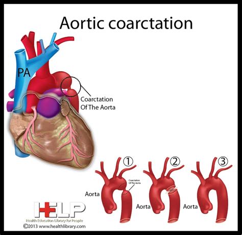 11 best Coarctation of the Aorta images on Pinterest | Chd awareness ...