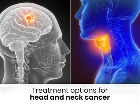 Treatment Options for Head and Neck Cancer | by Dr Tanmoy Kumar Mandal | Medium