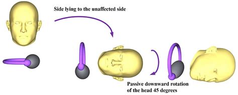 Frontiers | Case Report: New Application of a Gufoni Maneuver Variation for Apogeotropic Lateral ...