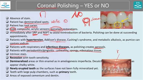 Indications and Contraindications for Coronal Polishing [StudentRDH ...