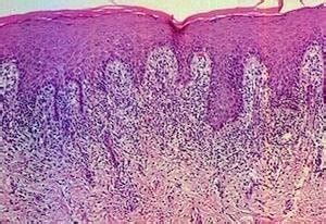 Lichen Planus Histology