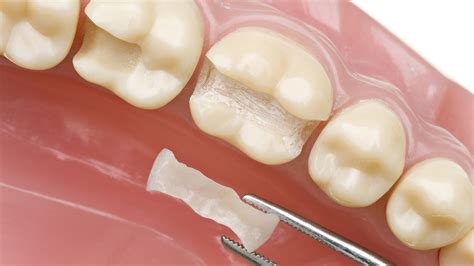 Inlays / Onlays - LQ Dental