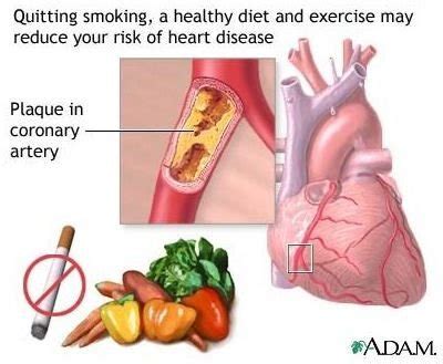 Prevention of Atherosclerosis: Learn the Risks and Steps for Prevention