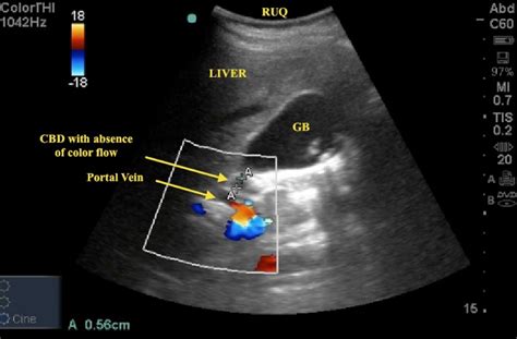 Biliary Ultrasound – Core EM