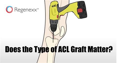 knee ACL surgery graft choices