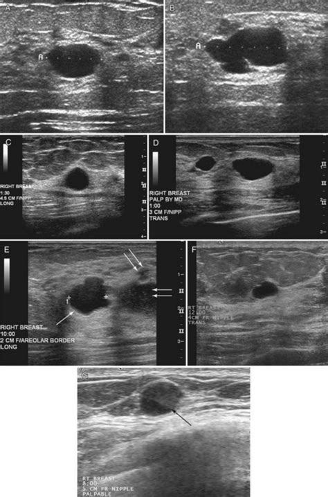 Breast Ultrasound Radiology Key