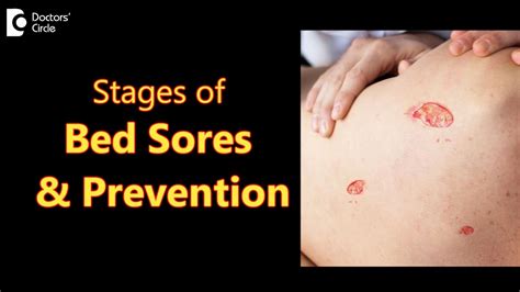 BED SORES (DECUBITUS ULCERS): Stages, Causes, Symptoms & Treatment-Dr ...