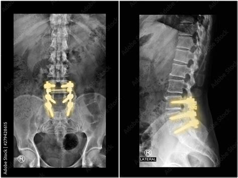 Fototapeta Film x-ray radiograph lumbar spine showing spinal stenosis ...