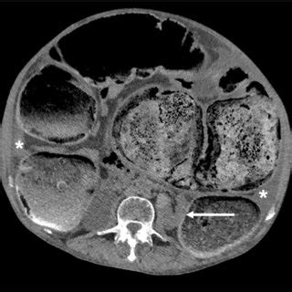 Abdominal CT scan revealing a severe fecal impaction. | Download Scientific Diagram