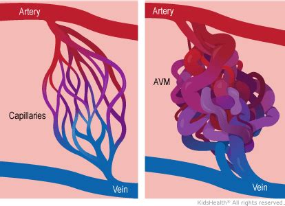 Arteriovenous Malformations (for Parents) - Nemours KidsHealth | Brain ...