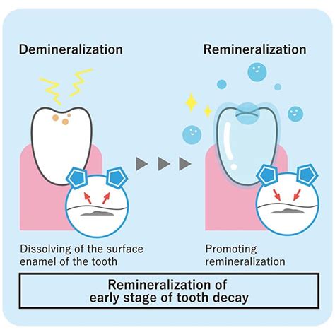 A study on tooth remineralization with a mineral-coated toothbrush | MISOKA LAB.