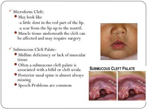 Cleftlipandpalate