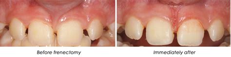 What is a Frenectomy? | Anderson Periodontal Wellness | Bloomfield Hills MI