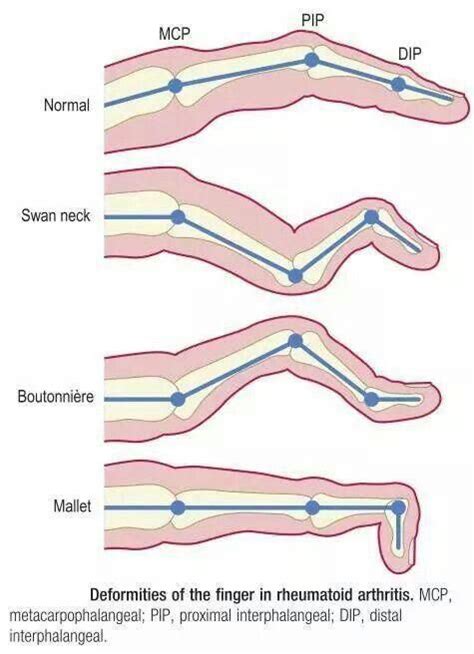 Rheumatoid Arthritis: Swan neck deformity vs boutonniere deformity ...