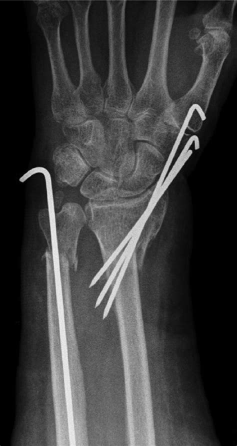 Distal Ulna Fracture Splint