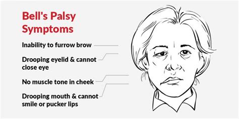 Bell's Palsy - My Complete Balance