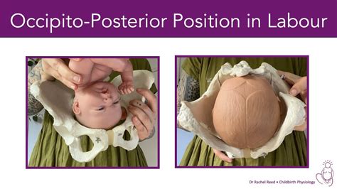 Occipito-Posterior Position (Back-to-Back) in Labour - YouTube