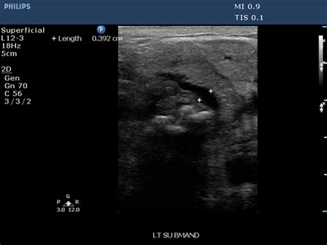 Submandibular Gland Stone Ultrasound