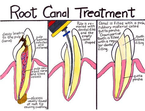 STEPS IN ROOT CANAL TREATMENT | DENTALORG.COM