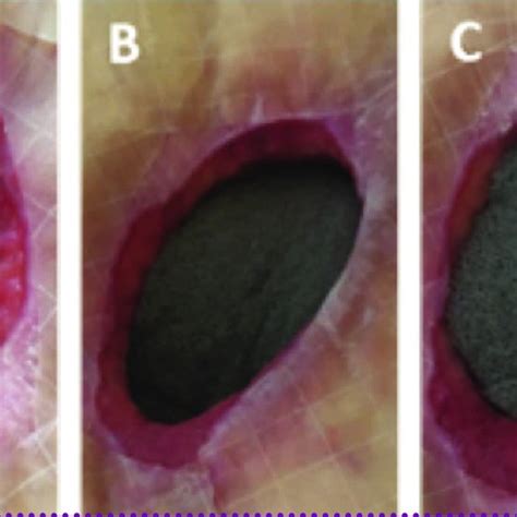 Columns of granulation tissue growing through the holes in the wound ...