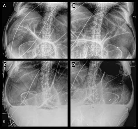 Non-toxic Megacolon Secondary to High-Grade Large-Bowel Obstruction ...