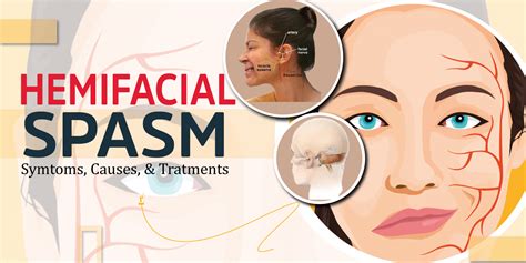 Hemifacial Spasm: Symptoms, Causes, and Treatments