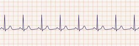 ECG INTERPRETATION FOR NCLEX: PART THREE - The Nurse Speak