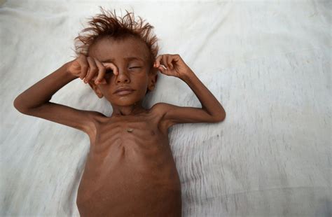 Famine Threatens Yemen Amid Civil War Photos | Image #141 - ABC News