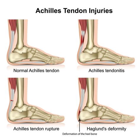 What Are The Signs of a Torn Achilles Tendon?