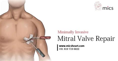 Minimally Invasive Mitral Valve Repair - MICS HEART