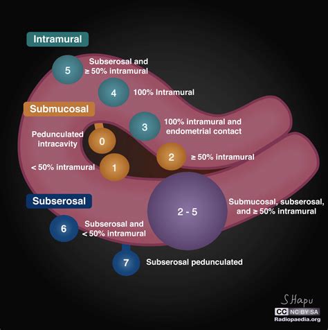 Fibroid Types, Sizes, Location, FIGO Classifications, 53% OFF